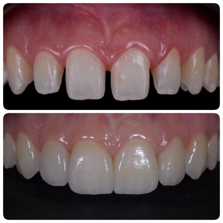 Lentes de contato dentais – Alessandra Cohen