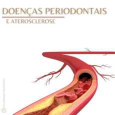 Doenças Periodontais e aterosclerose Doenças Periodontais e aterosclerose