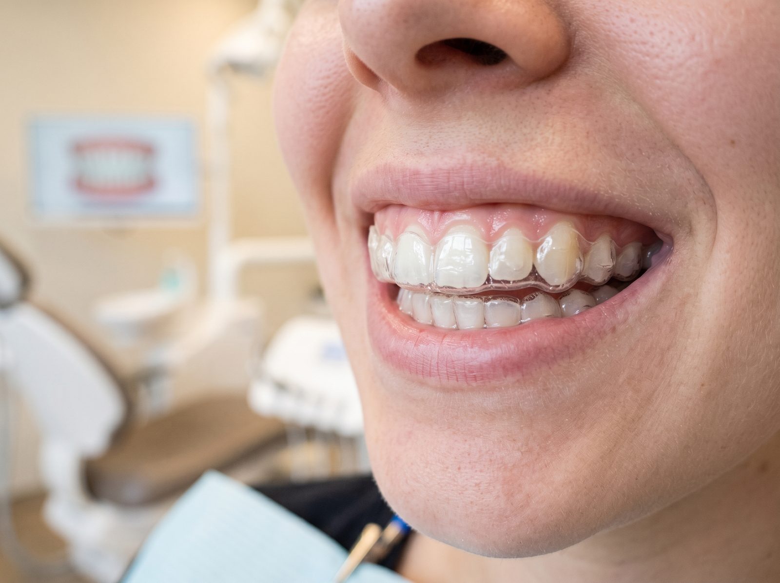 Moldeira transparente sob medida com gel clareador aplicada sobre os dentes